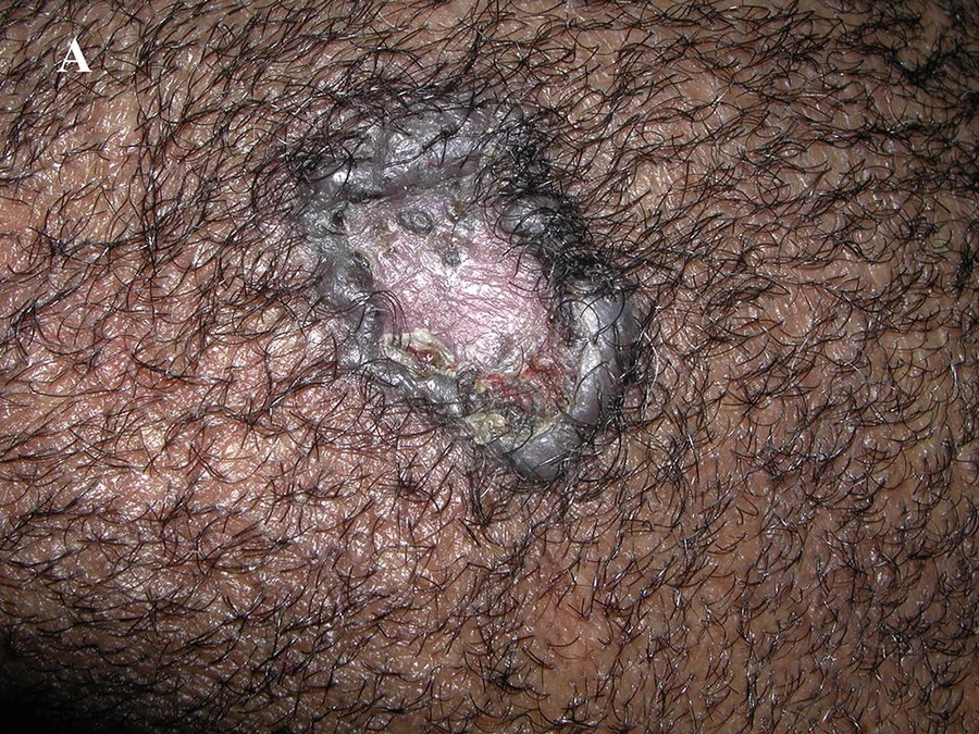 Ulcerated, crusted pink-white plaque with raised, rolled edges on hair-bearing dark brown skin, consistent with cutaneous squamous cell carcinoma.