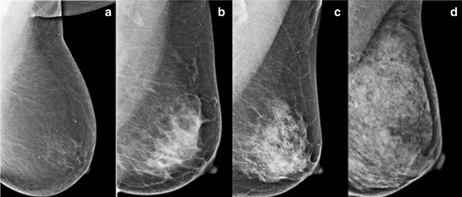 Four side-by-side mammogram images labeled a through d show increasing breast density: almost entirely fatty, scattered fibroglandular density, heterogeneously dense, and extremely dense tissue.