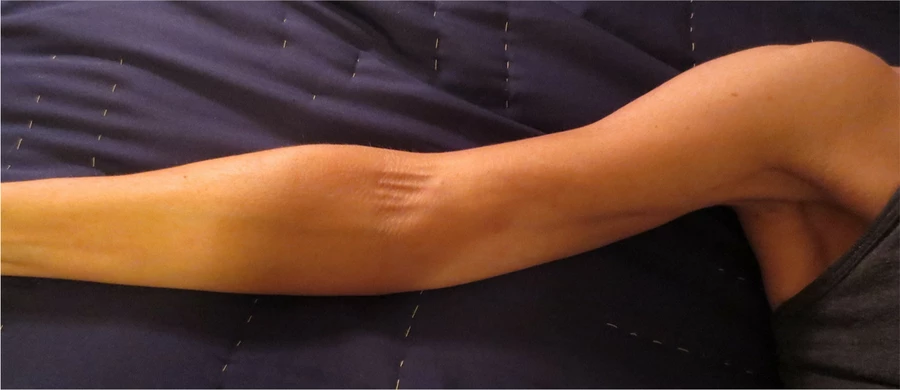 Right axilla and medial upper arm on light skin with multiple taut subcutaneous cords extending into the antecubital fossa, characteristic of axillary web syndrome.