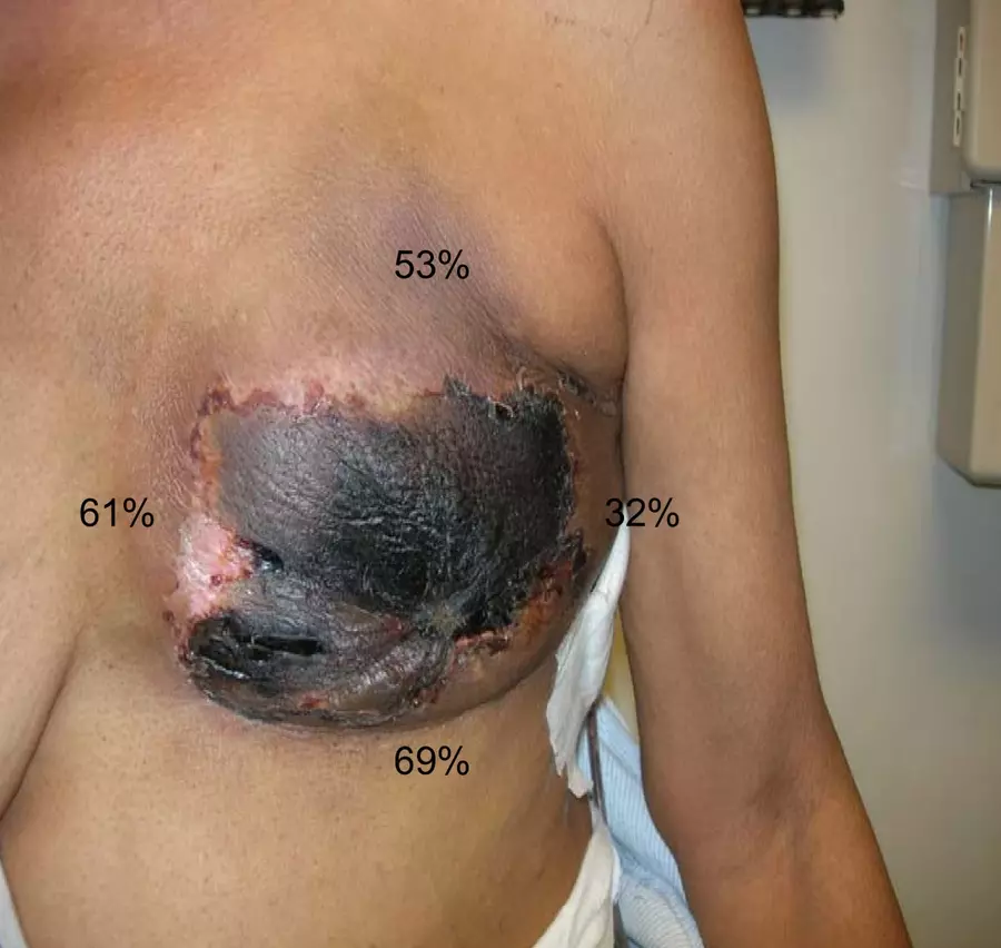 A large, open, bright red wound with patches of yellow, damaged tissue located along the surgical healing line at the bottom of the breast.