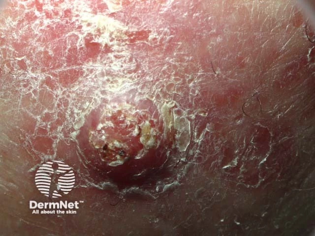 Dome-shaped, crusted, pink-red nodule with surface ulceration and surrounding scaly skin, characteristic of squamous cell carcinoma on light skin.