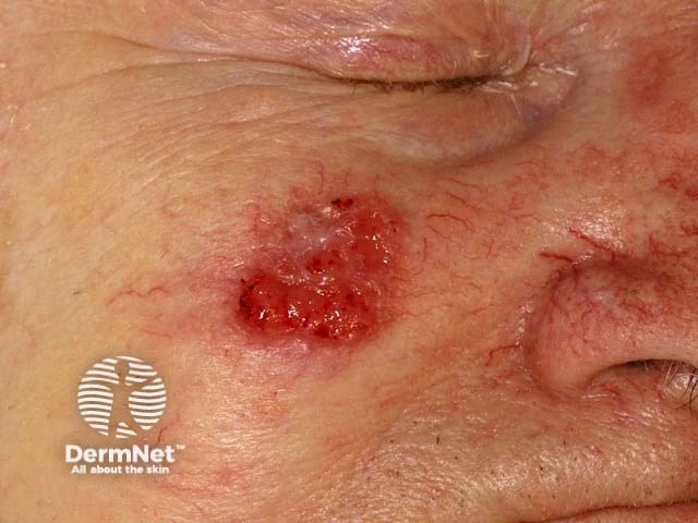 Red, crusted ulcerated plaque on the cheek near the eye and nose, with surrounding visible blood vessels, characteristic of squamous cell carcinoma on light skin.