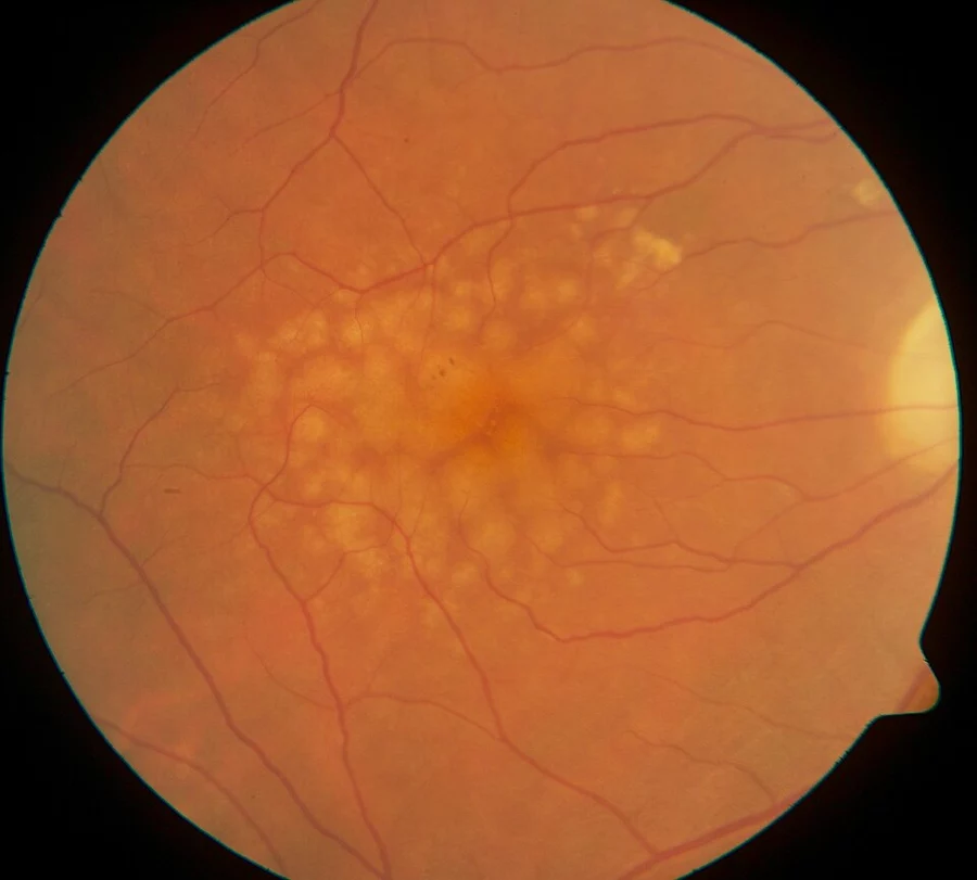 Retinal fundus photograph showing multiple larger, pale yellow soft drusen with blurred edges clustered in the macula.