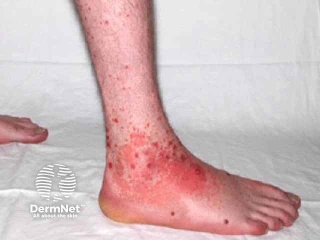 Red-purple purpura spots scattered across the lower leg and ankle with surrounding redness on light skin.