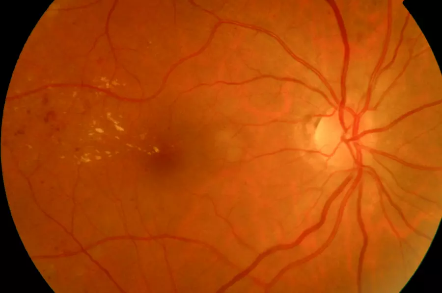Retinal fundus with multiple small, sharply defined yellow-white hard drusen in the macula, consistent with early age-related macular degeneration.
