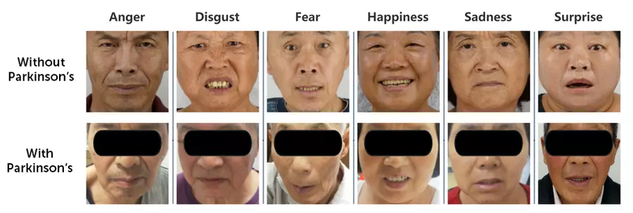 Before and after Parkinson’s masked face comparison across six emotions, with reduced expression in people with Parkinson’s.