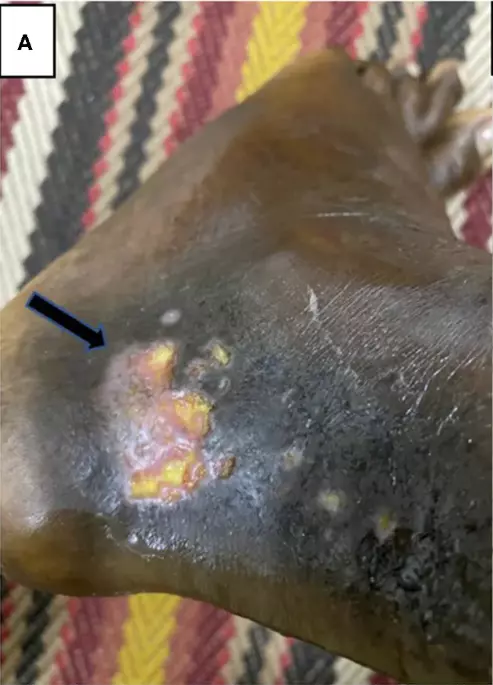 Photo of a sickle cell leg ulcer on a left ankle with dark skin.