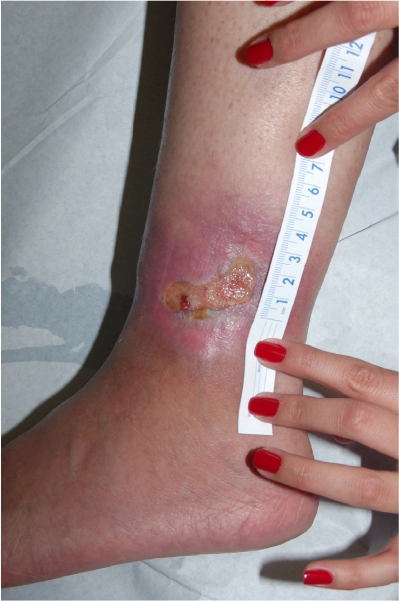 Photo of a leg with medium-light skin showing hands holding a measuring tape along a leg ulcer. The wound is approximately 4 inches long.