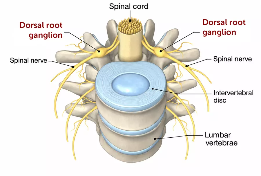 Lumbar spine diagram highlighting the dorsal root ganglia beside the spinal cord, with labels for spinal nerves, vertebrae, and an intervertebral disc.