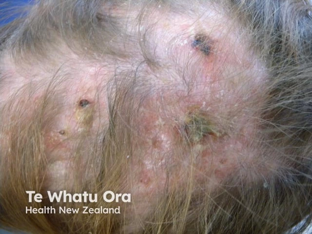 Patchy hair loss with inflamed, scaly, crusted lesions and scarring from systemic lupus erythematosus on a light-skinned scalp.